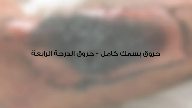 حروق بسمك كامل (حروق الدرجة الرابعة)